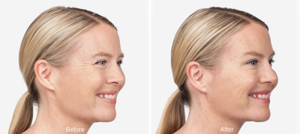 Before and after Botox at Summit Primary Care in West Jordan