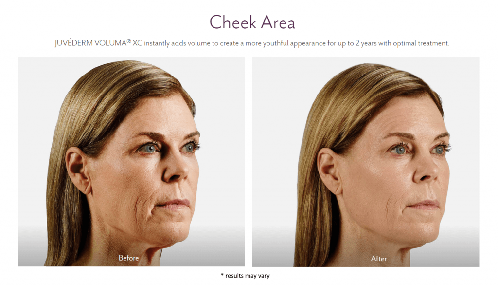 Before and after Juvederm fillers at Summit Primary Care in West Jordan