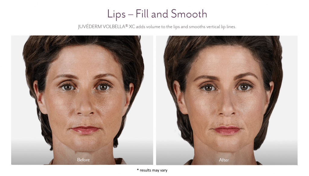 Before and after Juvederm fillers at Summit Primary Care in West Jordan