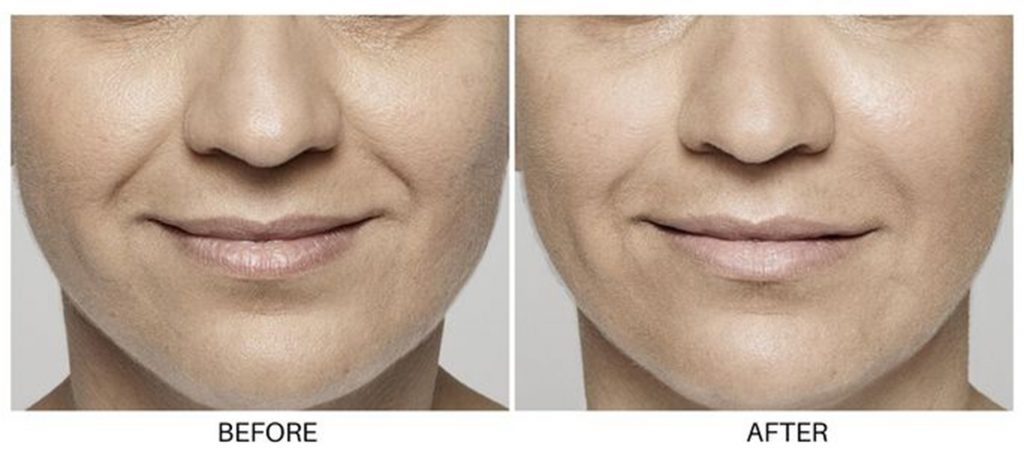Before and after Restalyne fillers at Summit Primary Care in West Jordan