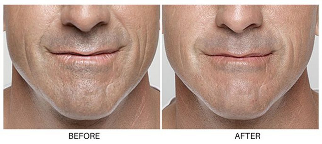 Before and after Restalyne fillers at Summit Primary Care in West Jordan